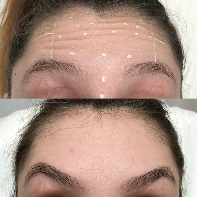 Diferenças Chave: Botox Preventivo vs. Corretivo - inspiração 1