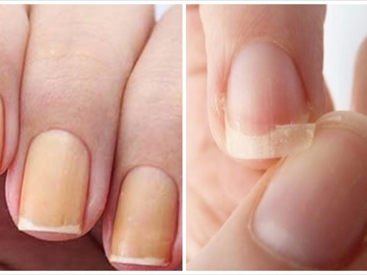 Mitos e Verdades sobre o Amarelamento das Unhas