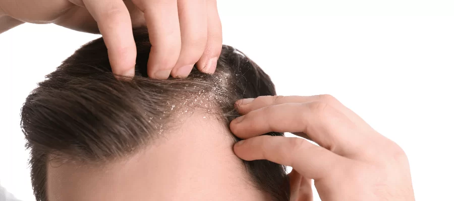 Desvendando a Dermatite Seborreica: Causas