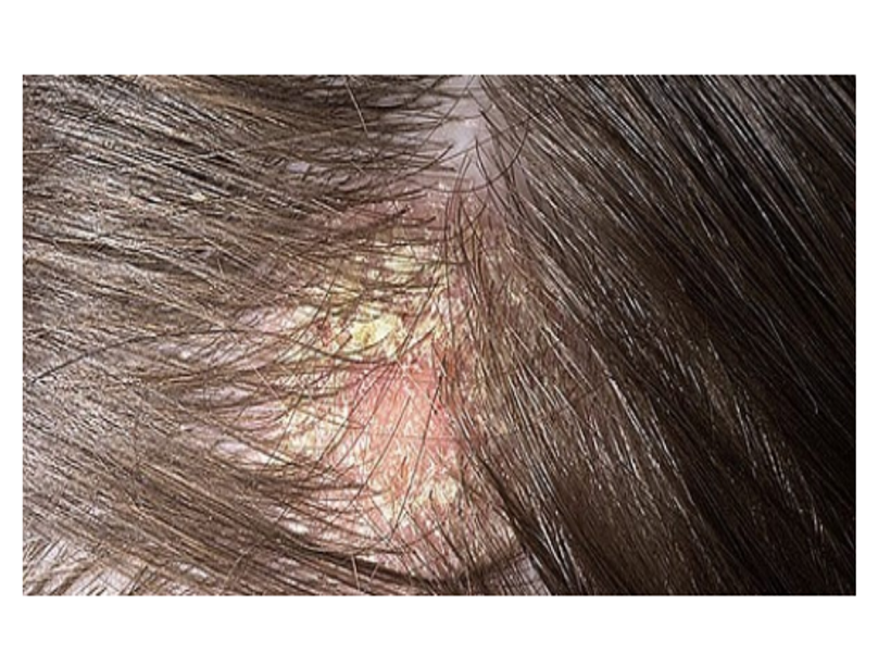 Melhores Shampoos Anticaspa: Guia Completo e Ativos Essenciais