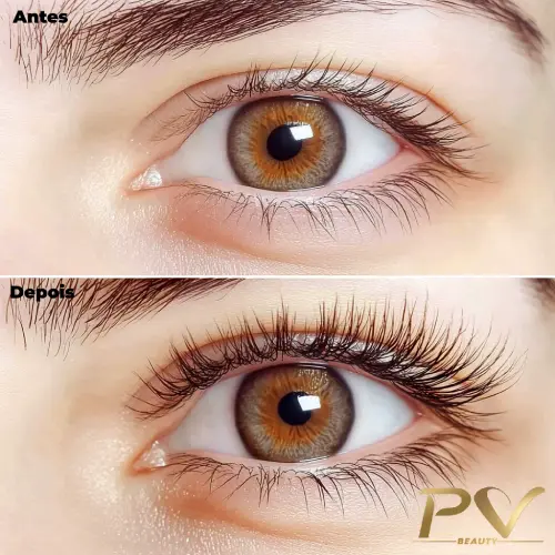 Blefaroplastia e Botox: Soluções Estéticas para Pálpebras Caídas