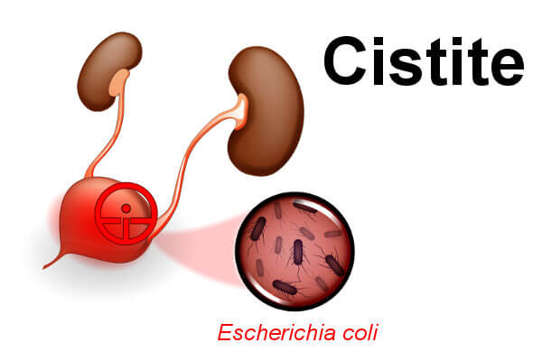cistite o que é