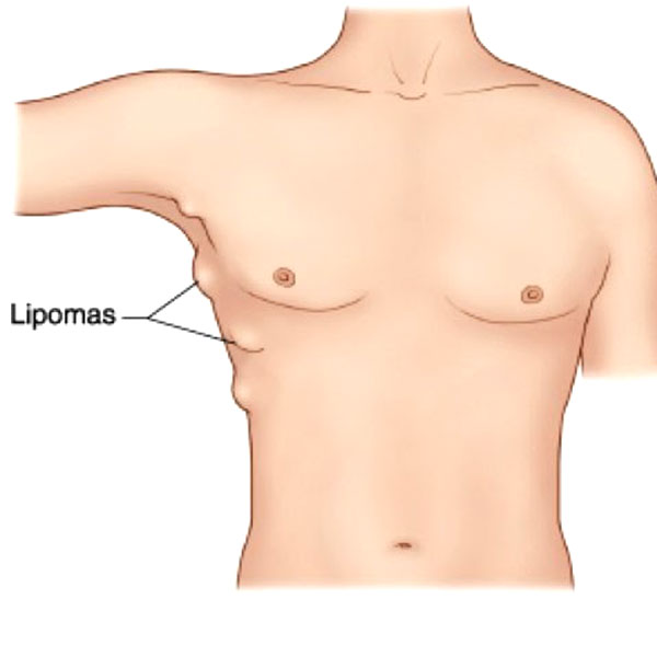 tipos de lipoma e suas características