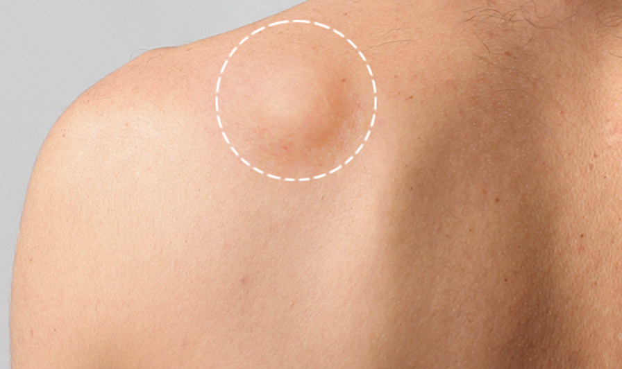erros comuns ao diagnosticar lipoma em casa