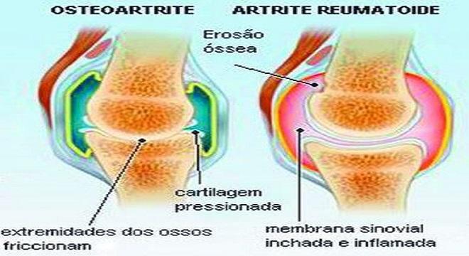 erros comuns no diagnóstico da artrite reumatoide