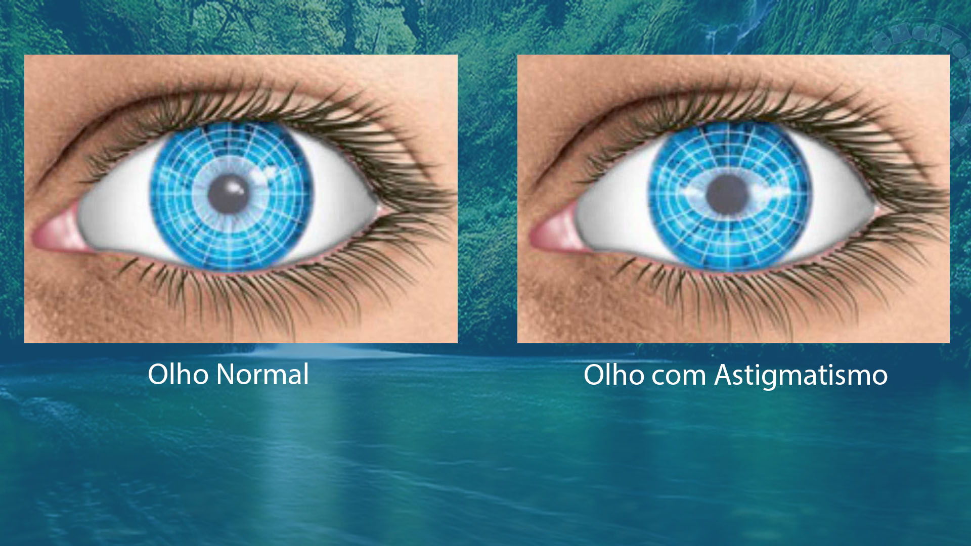 o que é astigmatismo e como corrigir