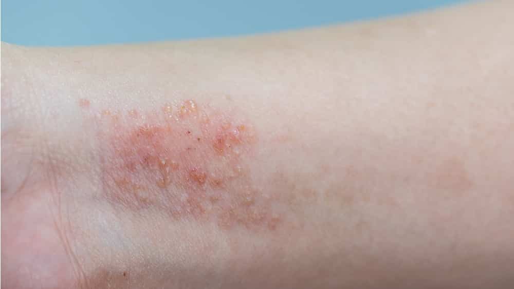 sintomas dermatite atópica bebês