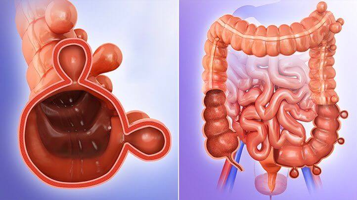 o que é diverticulose