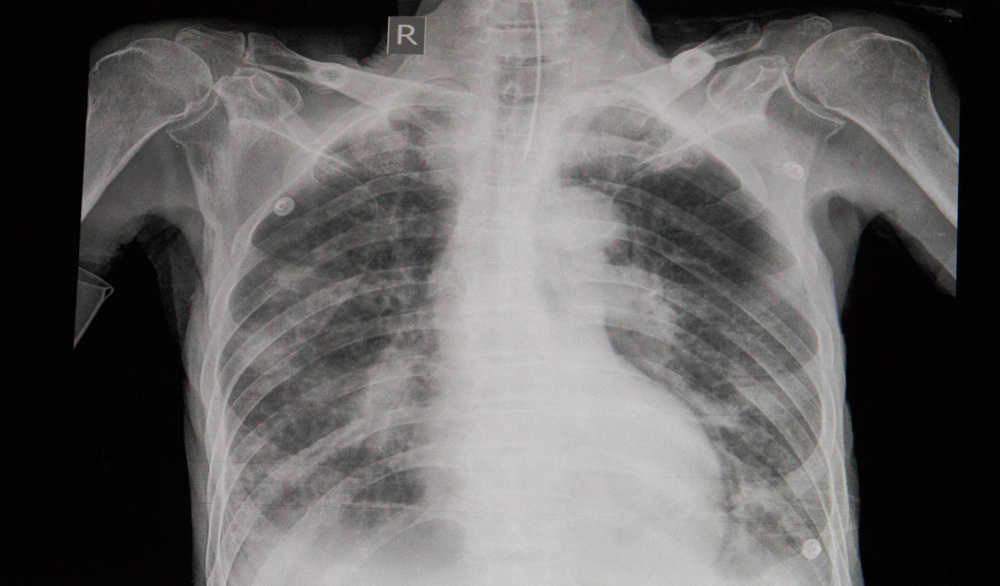insuficiência cardíaca e edema pulmonar