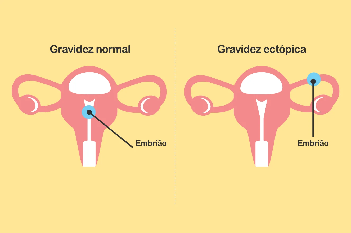 gravidez ectópica sintomas