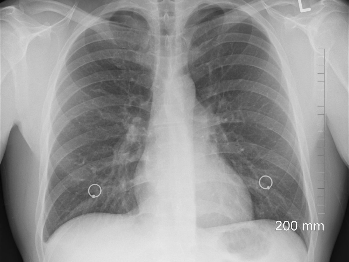 o que é pneumotórax