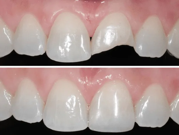 erros comuns ao escolher material de restauração dental