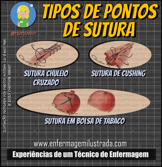 o que é sutura