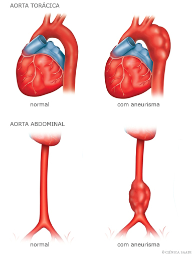 sintomas de aneurisma