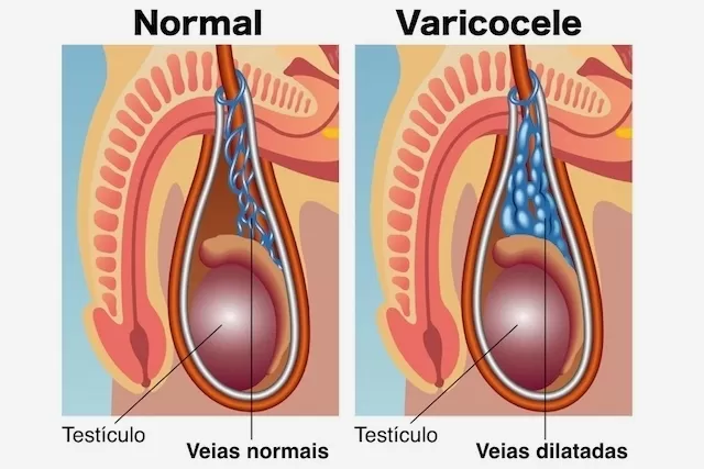varicocele causas