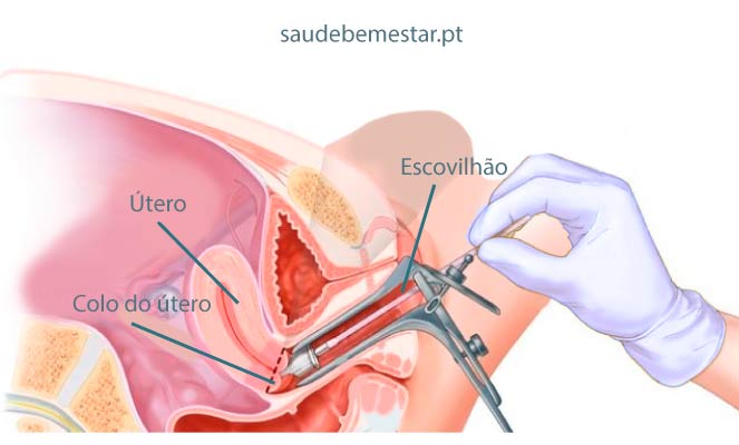 citologia oncótica cervical