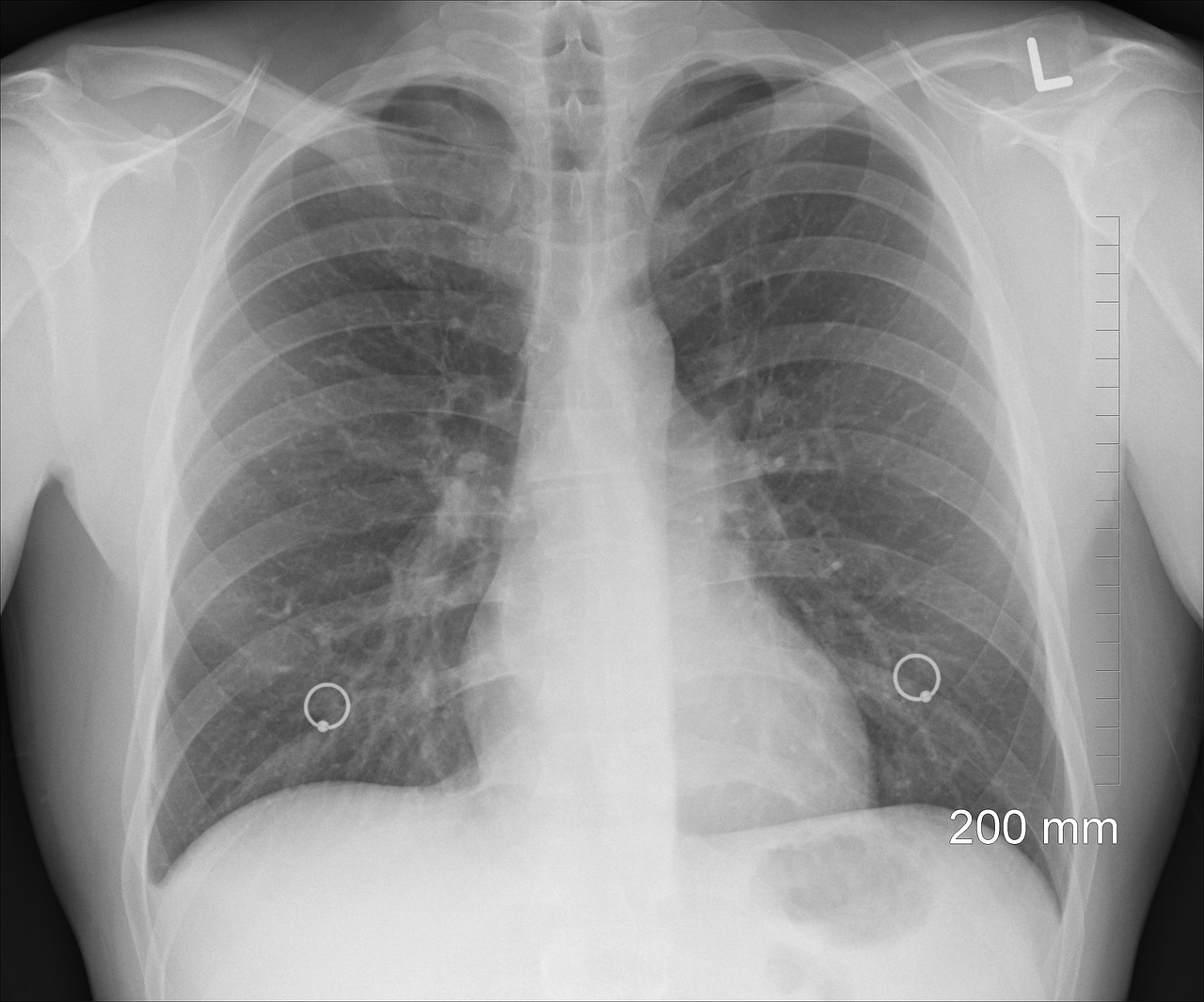 pneumotorax o que é